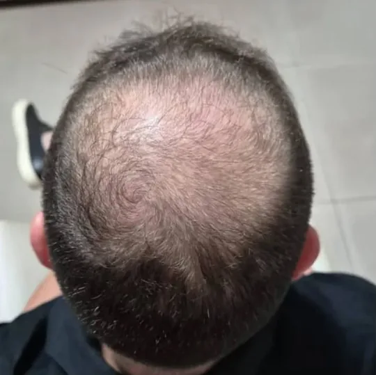 Coroa antes do transplante, com o couro cabeludo aparente