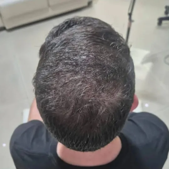 Coroa depois do transplante, preenchida de cabelo